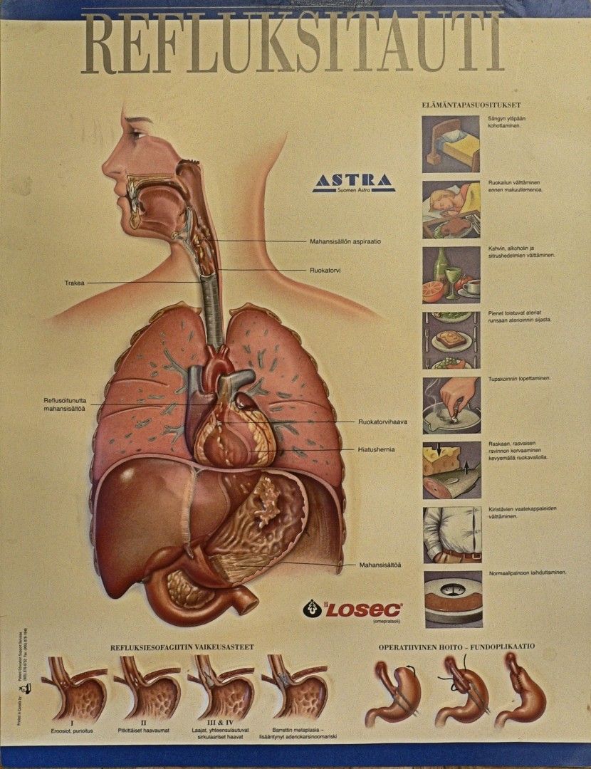 Anatominen kohokuvataulu Refluksitauti