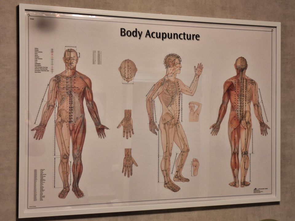Akupunktiokartta